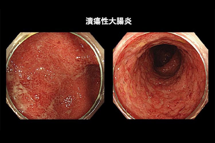 炎症性腸疾患